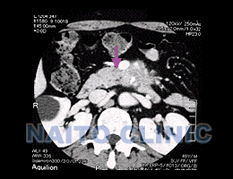 膵臓がん